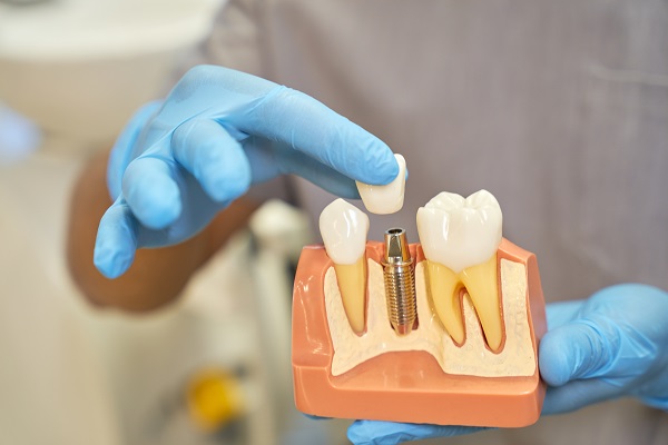 Implantologia-dentale-cosa-devi-sapere-prima-di-iniziare.jpg