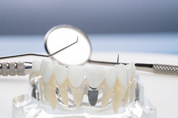 Osteointegrazione-impianti-dentali.jpg